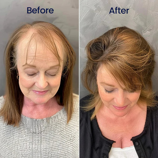 Sérum de Crescimento Capilar de Ação Rápida com 5% de Minoxidil de Força Máxima