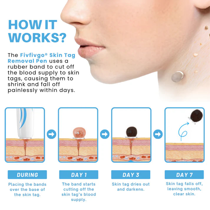 Caneta removedora de marcas de pele sem dor Fivfivgo® para uso doméstico