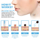 Caneta removedora de marcas de pele sem dor Fivfivgo® para uso doméstico