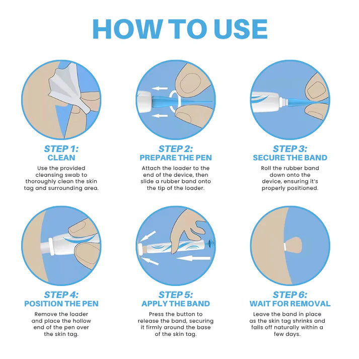 Caneta removedora de marcas de pele sem dor Fivfivgo® para uso doméstico