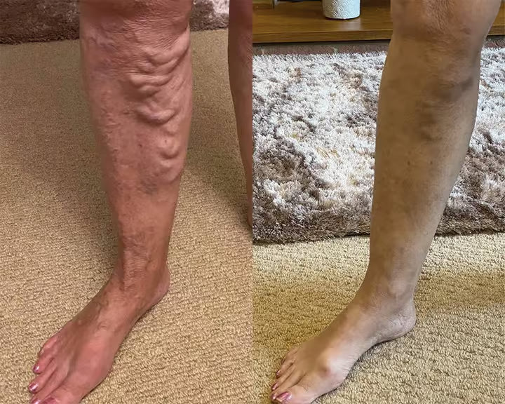 Spray fitoterápico Timilk® VeinGuard – ✅Clinicamente comprovado para eliminar varizes em apenas 7 dias.