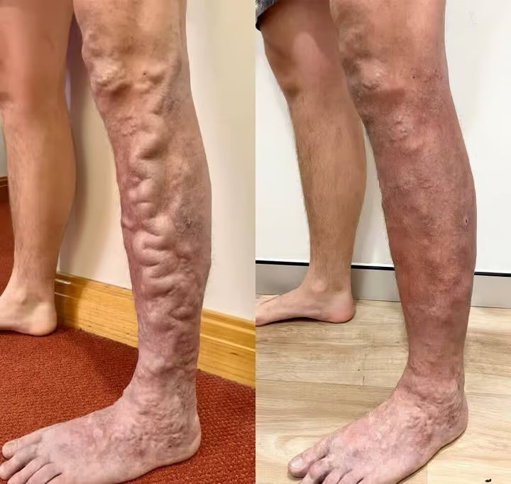 Spray fitoterápico Timilk® VeinGuard – ✅Clinicamente comprovado para eliminar varizes em apenas 7 dias.