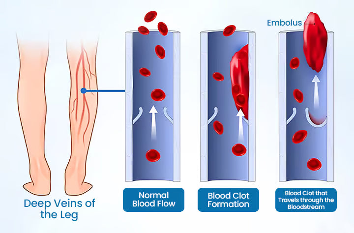 Spray fitoterápico Timilk® VeinGuard – ✅Clinicamente comprovado para eliminar varizes em apenas 7 dias.