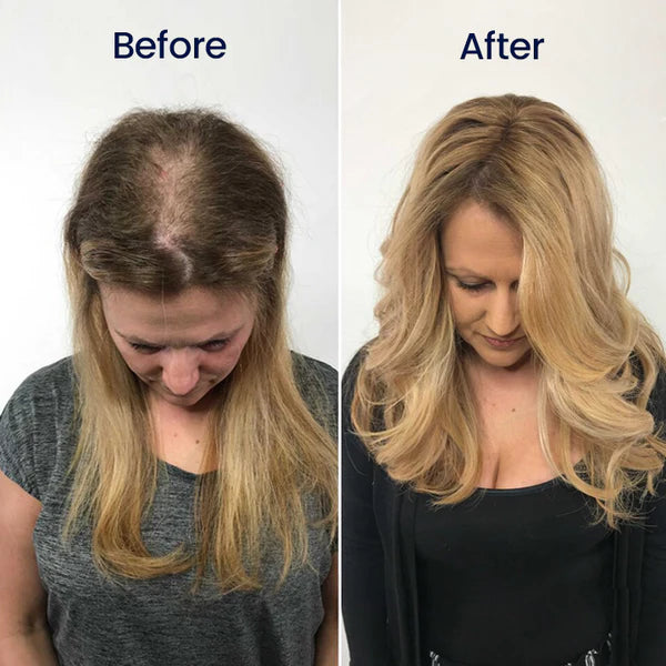 Sérum de Crescimento Capilar de Ação Rápida com 5% de Minoxidil de Força Máxima