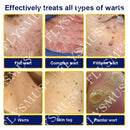 Spray de tratamento criogênico para verrugas cutâneas