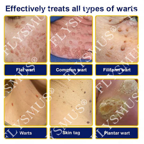 Spray de tratamento criogênico para verrugas cutâneas