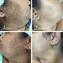 Spray de tratamento criogênico