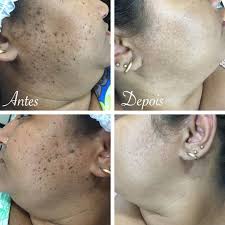 Spray de tratamento criogênico